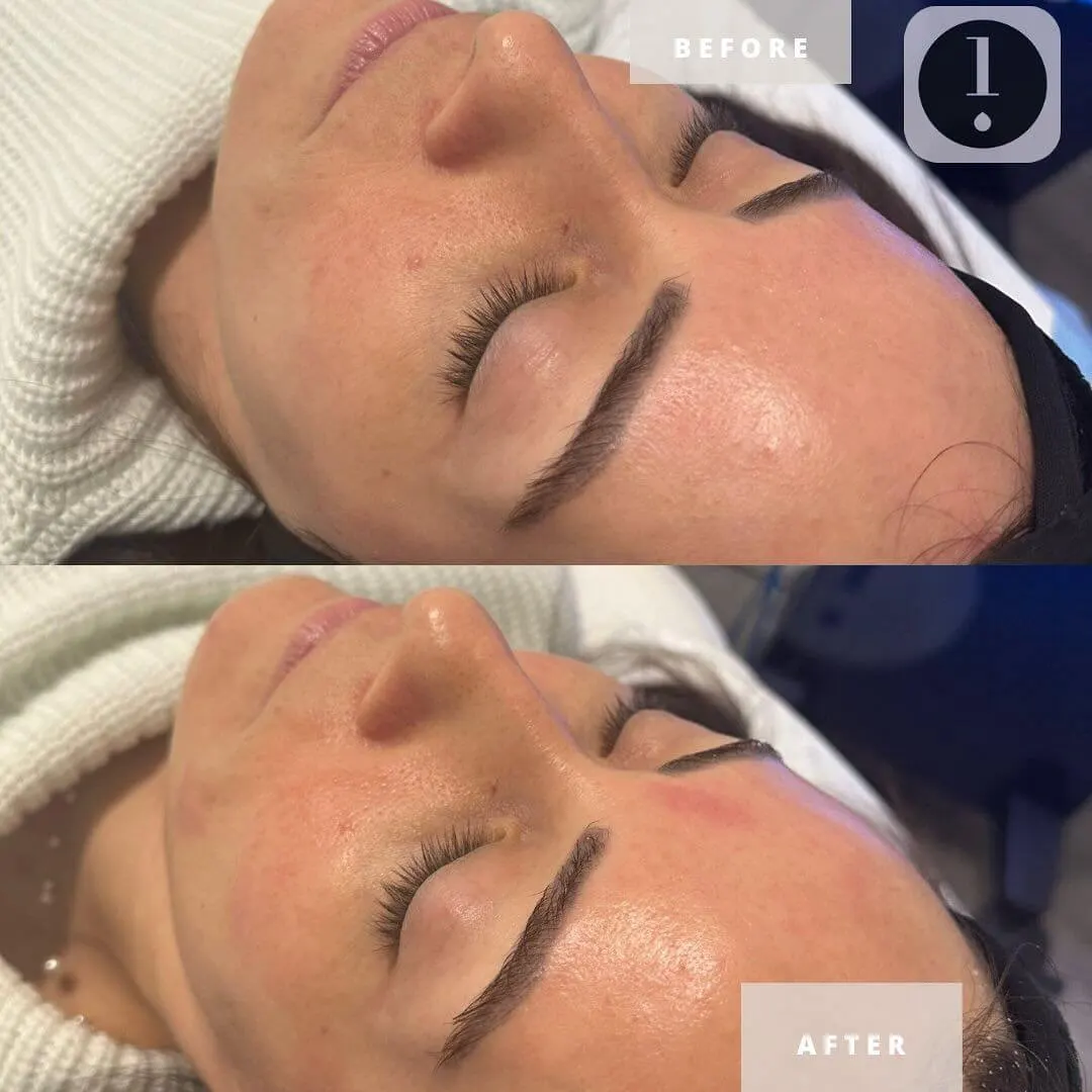 Treatment result