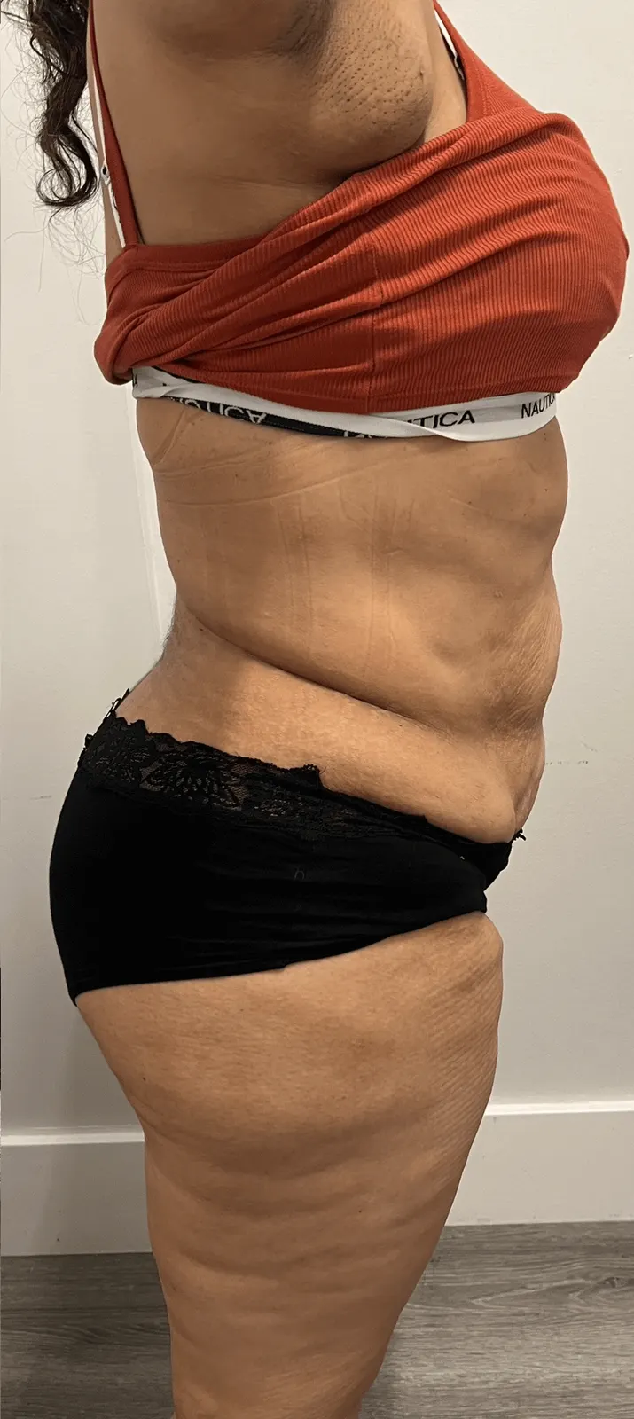 Body Treatments result, After