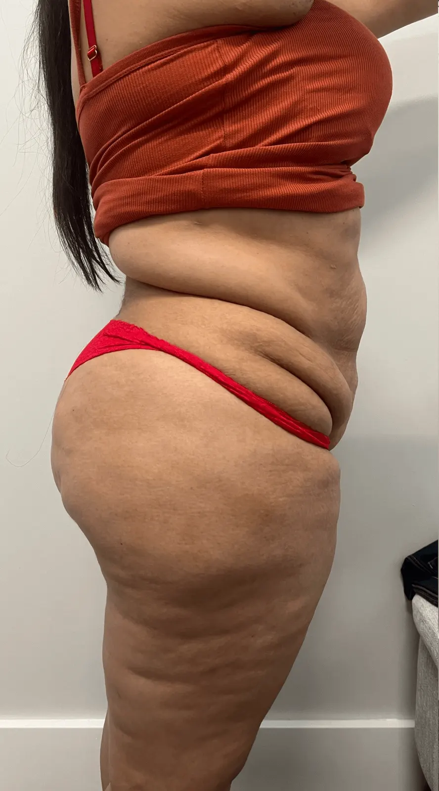 Body Treatments result, Before
